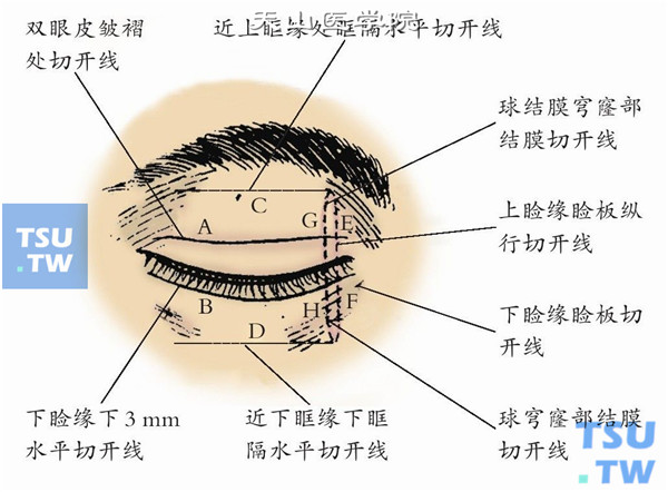 B为下睑缘下2mm水平切口线。  C为上眶缘处肌层下眶隔切开线。  D为下眶缘肌层下眶隔水平切开线。  E为上睑睑板垂直切开线，离泪小点3mm。  F为下睑睑板垂直切开线，离下泪小点3mm。  G为上下睑缘全层切开线。  H为上下穹窿部和球结膜切开线与上下睑板连接成联合切口线。