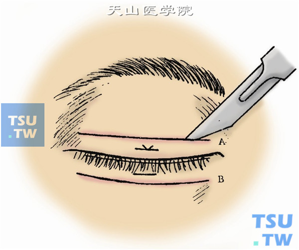 按上述切口线作切口。先沿上睑皮皱褶处切口线切开