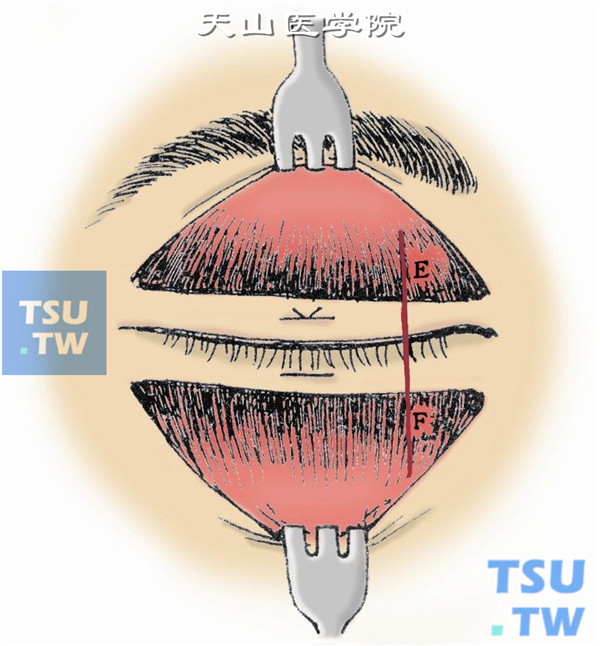 沿上、下睑缘睑板纵行线切开