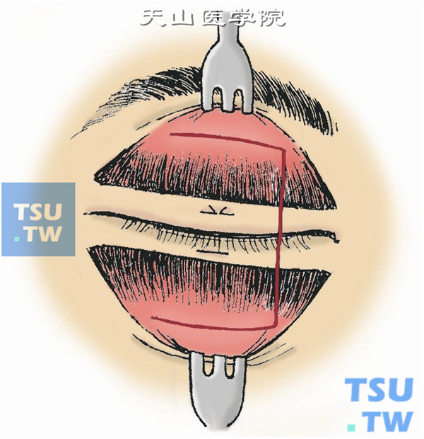 沿近上、下眶缘上、下眶隔水平线切开