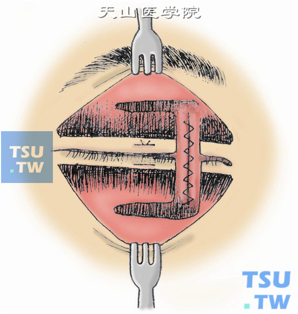 按图9、图10、图11所示按层缝合眶隔、球结膜、睑板、睑缘、皮肤切口