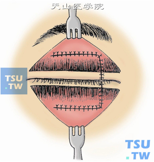 按图9、图10、图11所示按层缝合眶隔、球结膜、睑板、睑缘、皮肤切口
