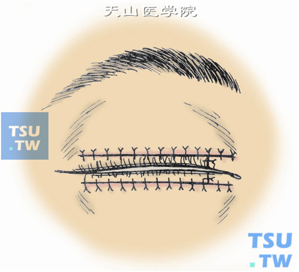 按图9、图10、图11所示按层缝合眶隔、球结膜、睑板、睑缘、皮肤切口