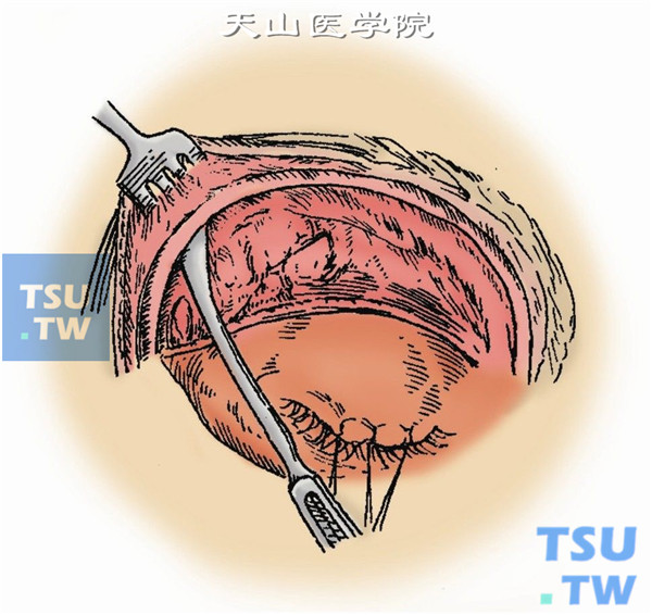 分离骨膜