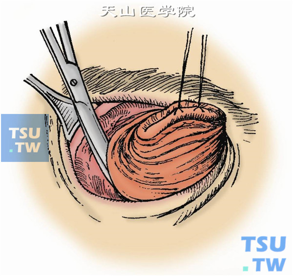 眶内容摘除。用深部弯血管钳夹紧眶尖部骨膜，再伸入扁桃体摘除剪在钳前剪断之