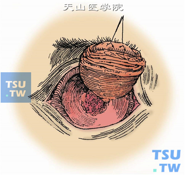 摘除肿瘤等眶内容物