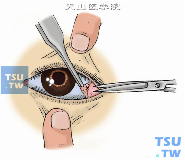 必要时切开外眦韧带。分离范围宜大些，以防因结膜退缩而使外眦部切口再愈合