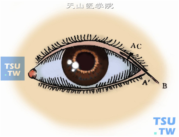 在上下睑缘外侧1/4睑缘灰线处劈开眼睑，按AA'C及BC切开，并与上睑缘切口相连。于切口区做潜行分离，范围不超过B点，此时C点退缩至A点，缝合A点与C点