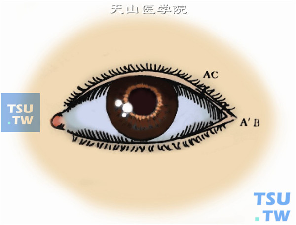 再将A′点与B点缝合