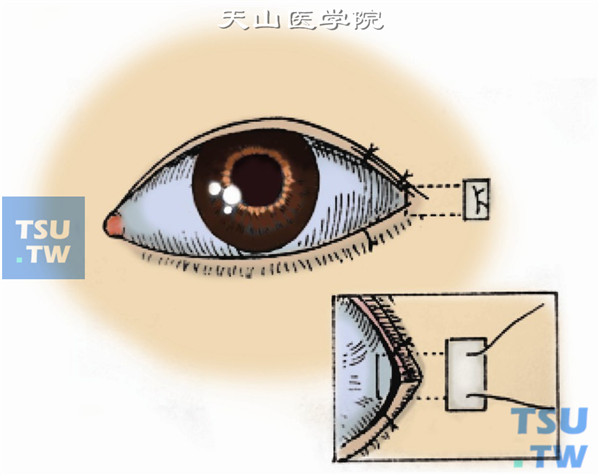 用5-0丝线将结膜切缘与皮肤创缘缝合，并用3-0丝线于外穹窿与结膜做以褥式缝合，以形成外眦穹窿