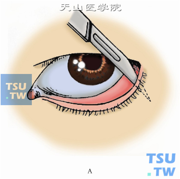 分离睑板结膜及皮肤肌肉