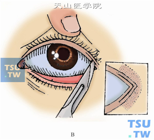 分离睑板结膜及皮肤肌肉