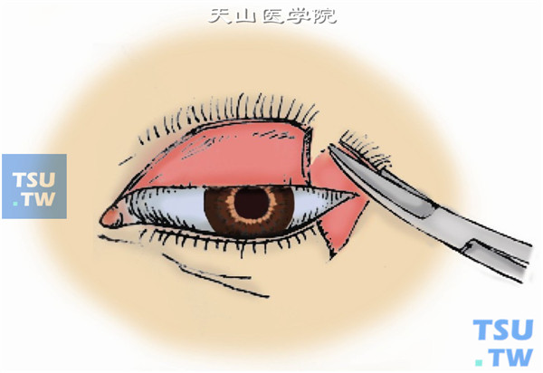 剪去睑缘。然后把相对处未切除的皮肤肌肉层沿睑板切断处垂直切开