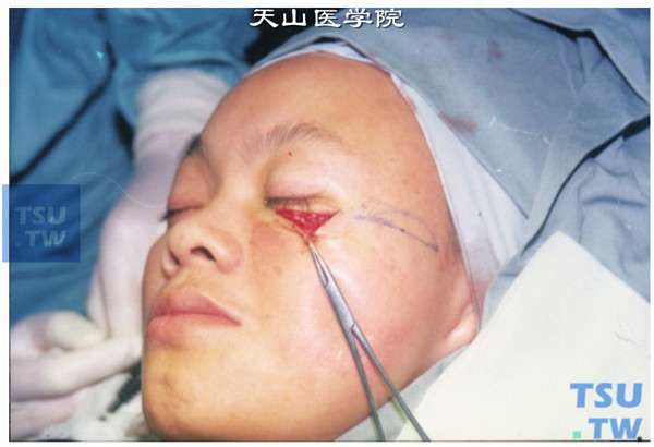睑裂斑 手术图片