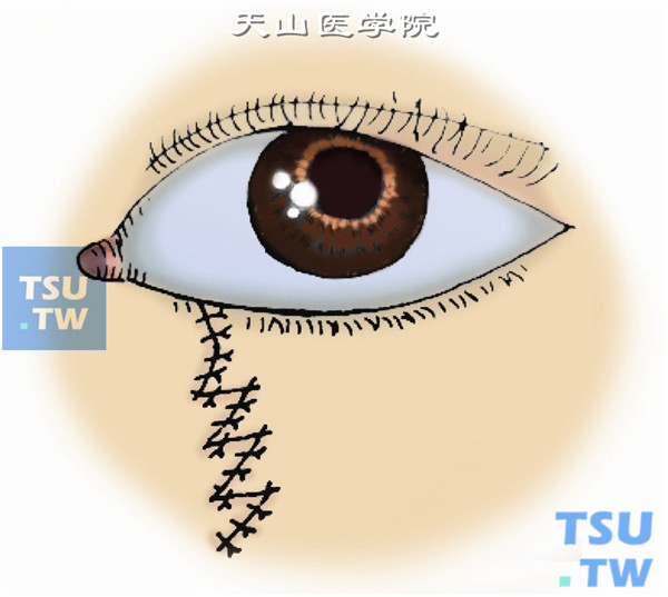 沿条索瘢痕切开，彻底切除瘢痕组织，以条索切口为纵轴两侧作多个或单个横臂。横臂与纵轴以30°～45°角为宜。切开横臂，锐性游离各三角瓣并交错缝合