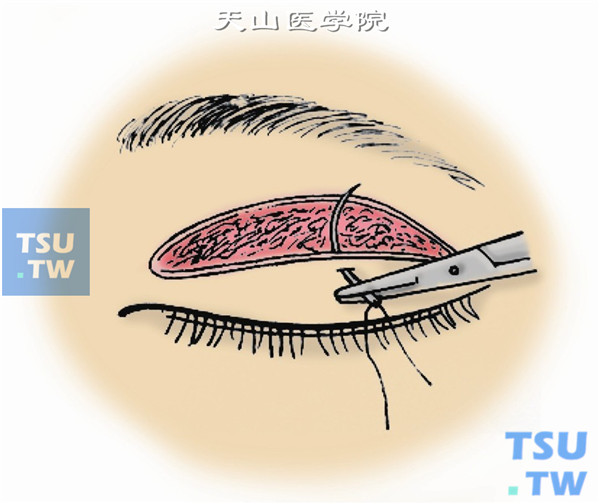 眶隔切口不需缝合，但要注意止血，且勿伤及上睑提肌。再以5-0丝线在切口中间先缝一针。缝针先穿过近睑缘侧皮肤，再在睑板前浅层组织内穿过