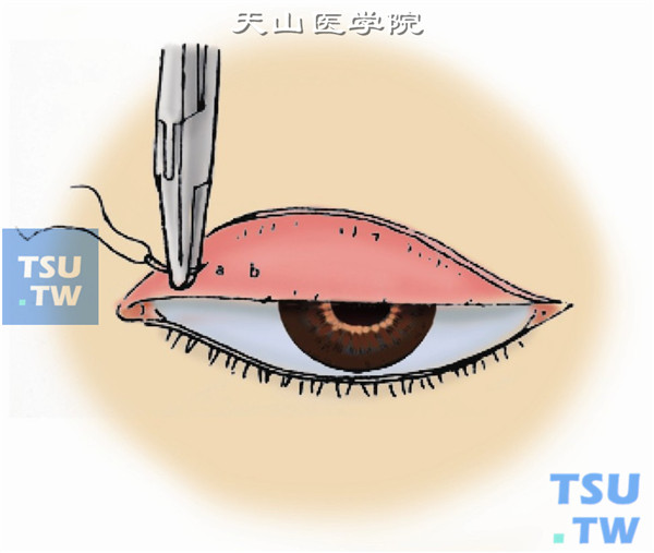 翻转上睑暴露睑板上缘，从睑板上缘穹窿结膜进针