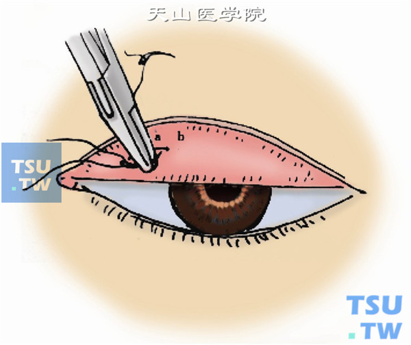 进出针应在同一平面