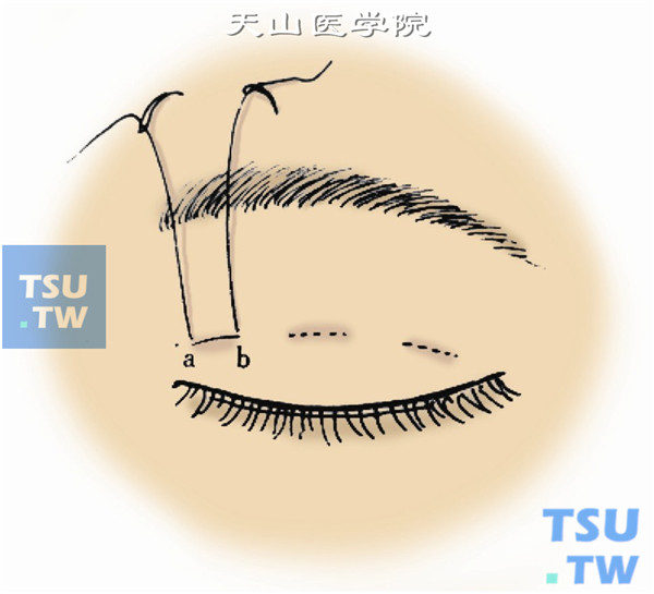 每针的2个出针点间距为3～4mm