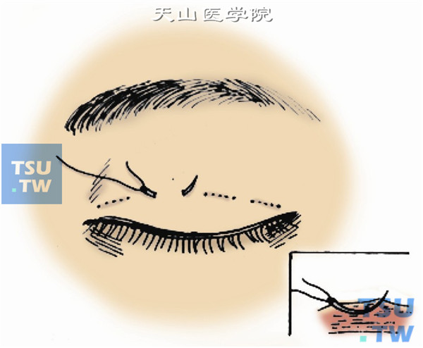 先在中间两点进针，用6-0丝线或5-0尼龙线，触及睑板后略退少许，穿针跨度约4mm出针