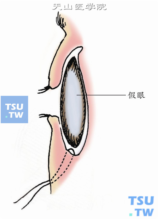 直接放入义眼，上下睑缘暂时性缝合固定。在义眼前放置婴儿输液硅胶管一根，各打2～3个侧孔，自内眦角向外眦角安放，上接抗生素溶液，定时冲洗结膜防止感染