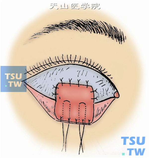 将此缝于结膜缺损面上，同上法固定缝合安放义眼，并做冲洗引流装置后，再缝合上下睑