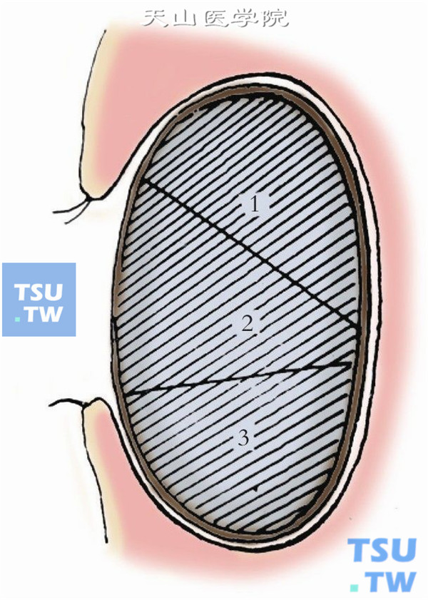 依上法切开结膜，剥离腔囊，下达眶下缘暴露眶下缘骨膜2～3mm，上达上穹窿部，囊腔冲洗后用盐水纱布填塞止血。用印模胶制成眼模两只，较义眼为大，其下缘与眶下缘骨膜相接触。将印模胶剖成二半成三片，以便术后取出