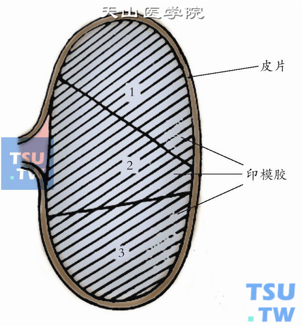 将中厚皮片组织面向外缝包于眼模上，缝于睑裂部位，将其塞入眶内