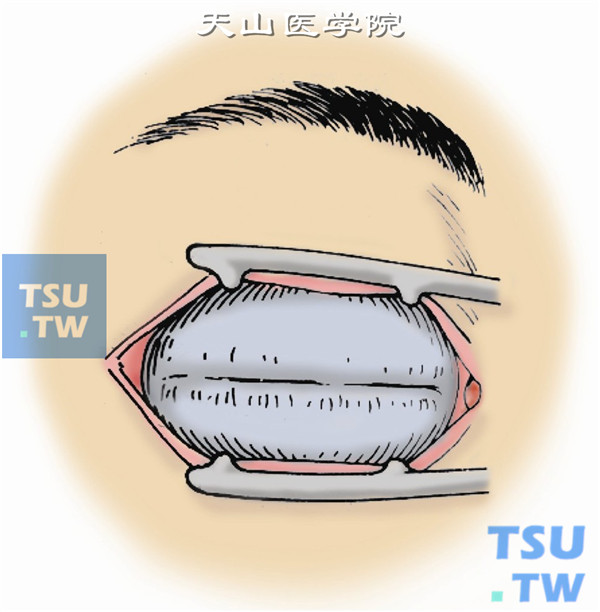 最后于缝合的睑裂下放冲洗用的硅胶管，外加压力敷料包扎