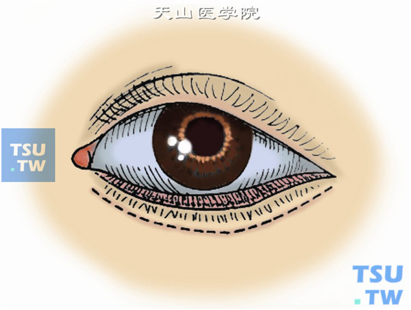 术区距睑缘3mm处作与睑缘平行的切口，外眦部可沿鱼尾纹少许延伸5mm，内眦部可超越眦角而达鼻根部侧面