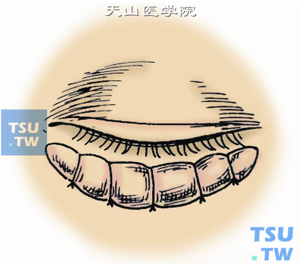 覆盖油纱布，再放纱头一小团，然后加压打包。包裹四周以油纱条围绕一周，外加油纱布包扎